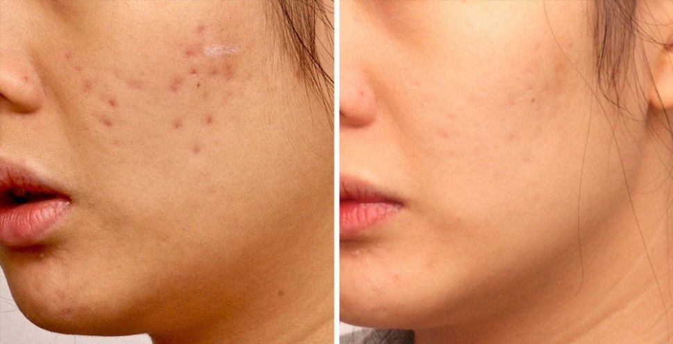 Lăn kim giúp làm đầy hiệu quả đến 90% sẹo lõm