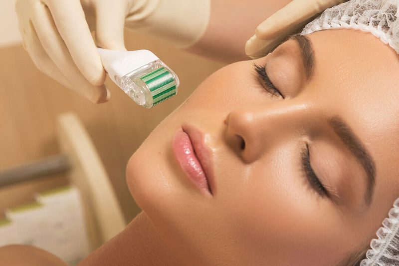 Ưu điểm khi lăn kim điều trị sẹo lõm