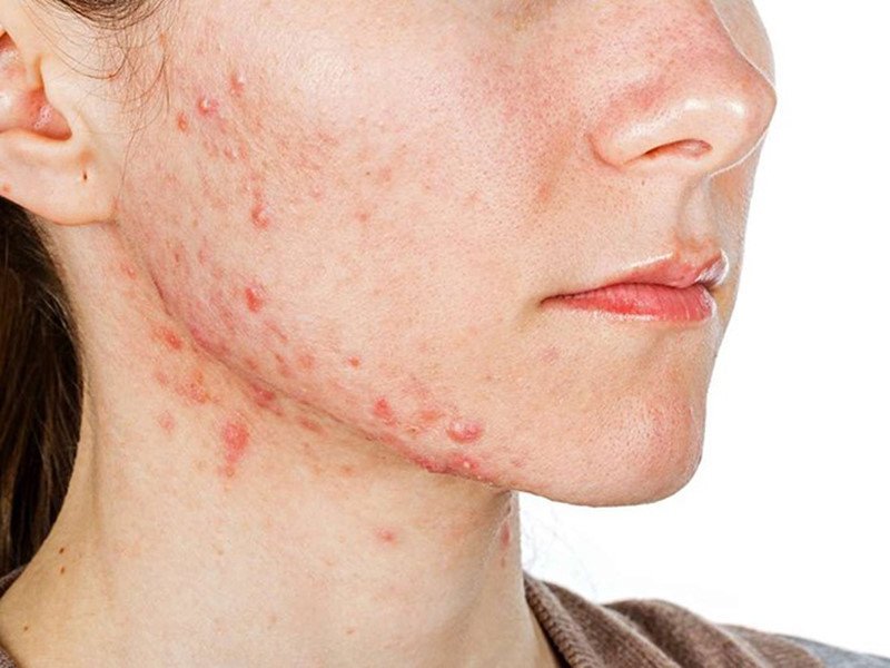 Da bị viêm nhiễm nặng
